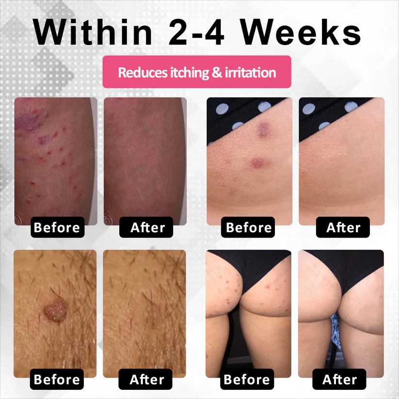 Woman's Genital HPV Healing Cream (BUY 1 GET 1 FREE)