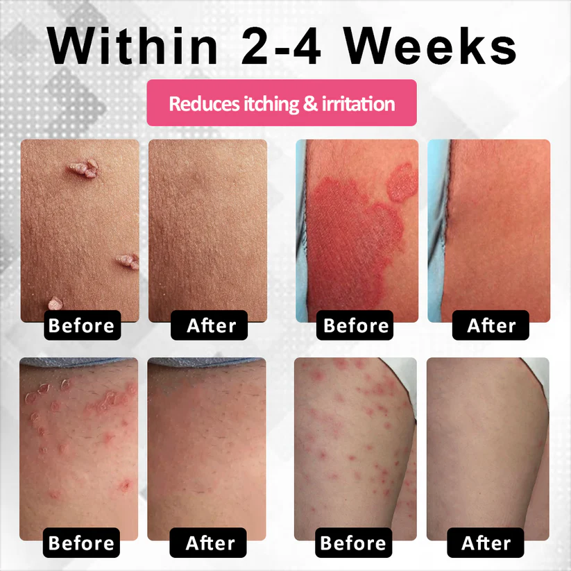 Woman's Genital HPV Healing Cream (BUY 1 GET 1 FREE)