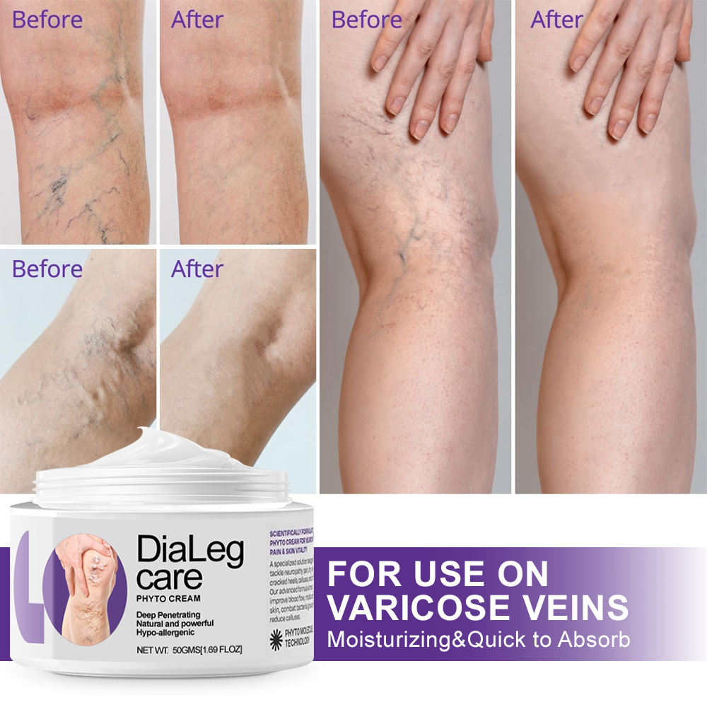 โ
๐Guitarrraยฎ๐๐ข๐๐๐๐ ๐๐๐ซ๐ ๐๐ก๐ฒ๐ญ๐จ ๐๐ซ๐๐๐ฆ - Helps Treat Varicose Veins, Swelling, Cramps, and Leg Pain