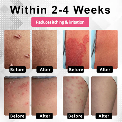 Woman's Genital HPV Healing Cream (BUY 1 GET 1 FREE)